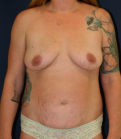 Feel Beautiful - Mommy Makeover 212 - Before Photo